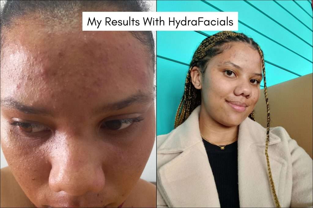 hydrafacial benefits for acne
