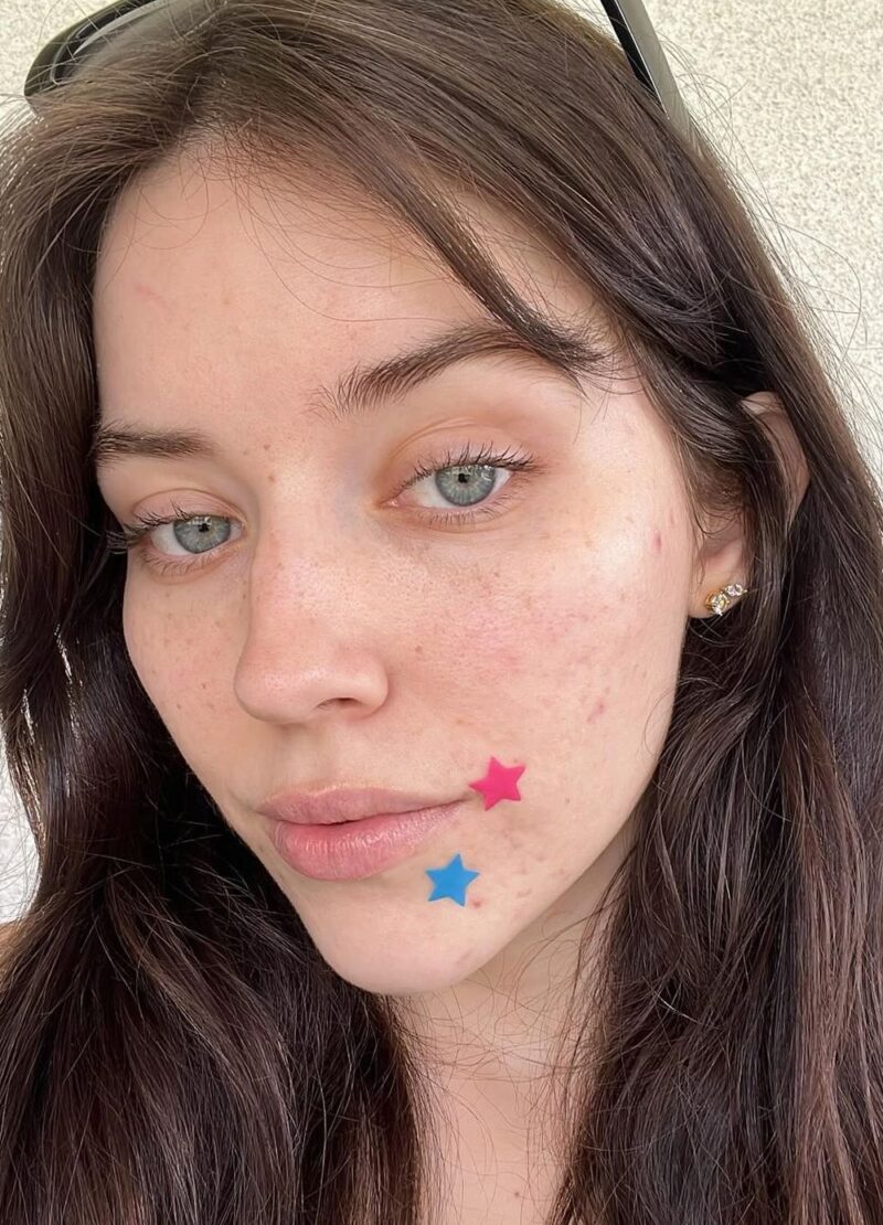 get rid of acne overnight